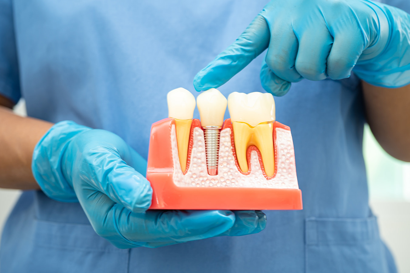 Dental Implants