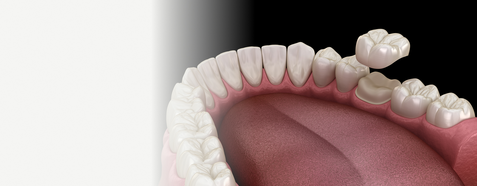 Dental Crowns Image