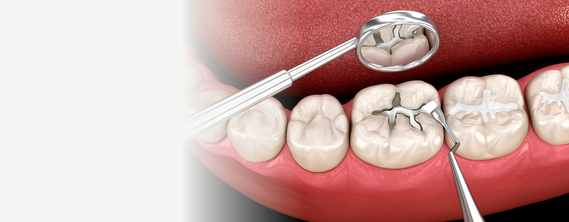Dental Fillings Image