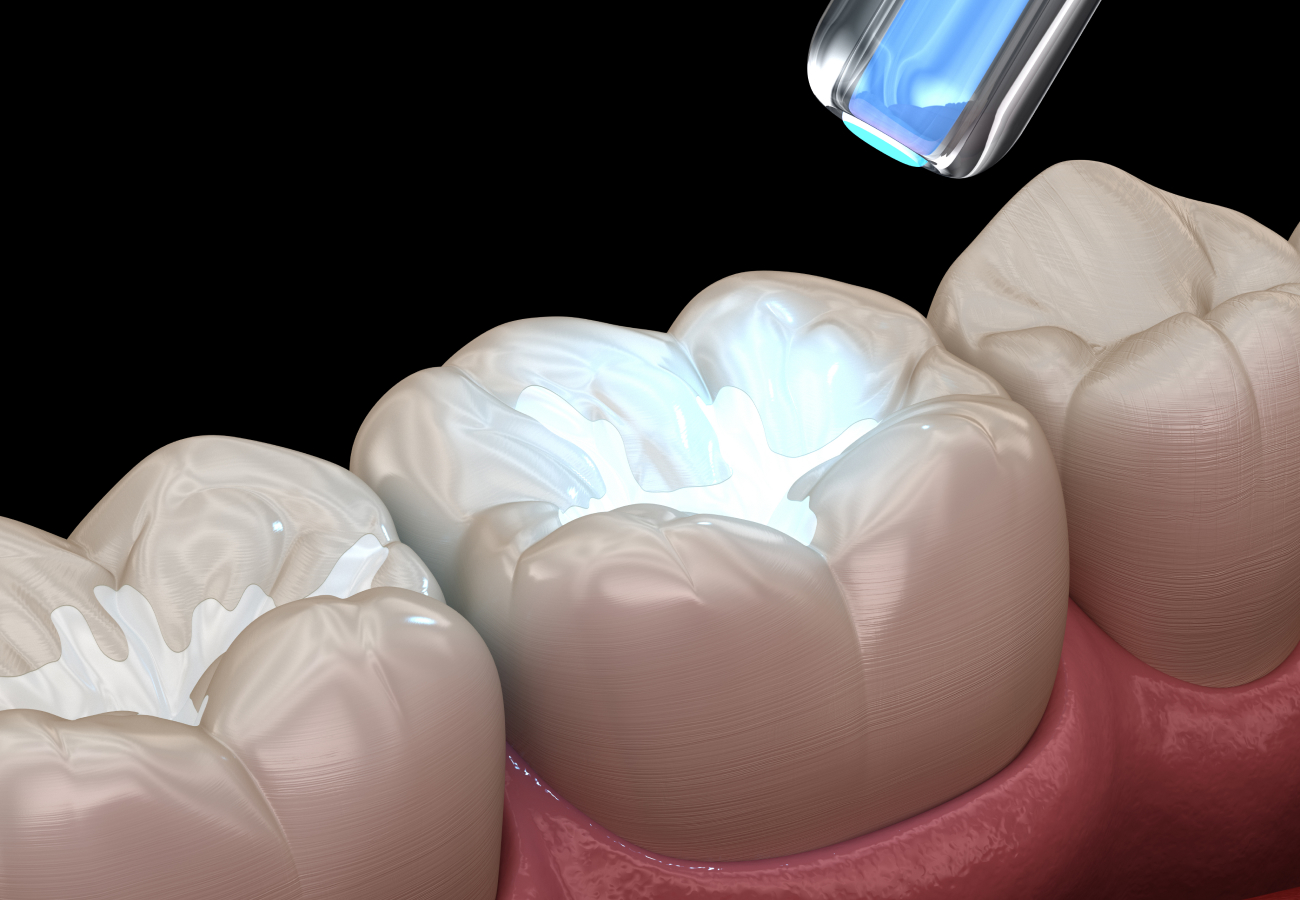 Dental Fillings