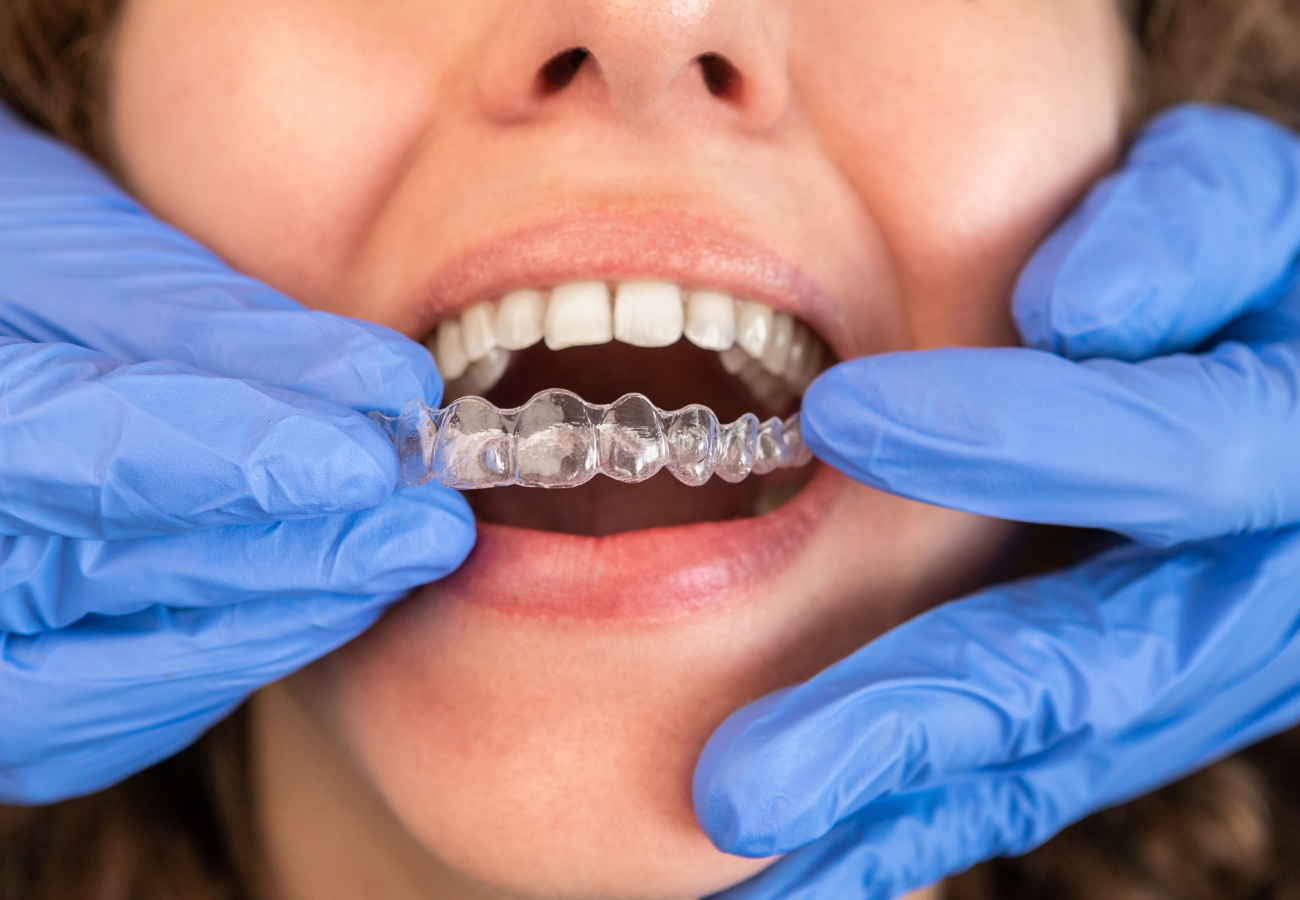 Invisalign