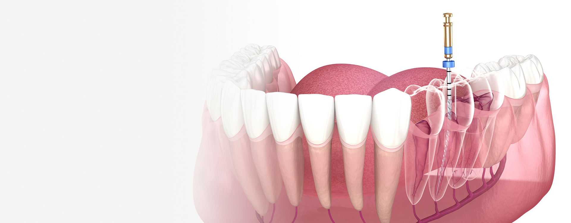 Root Canal Therapy Image