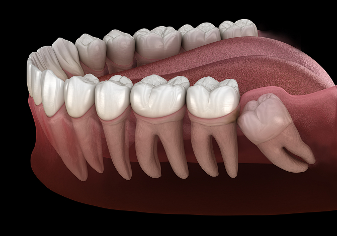 Wisdom Tooth Removal Image
